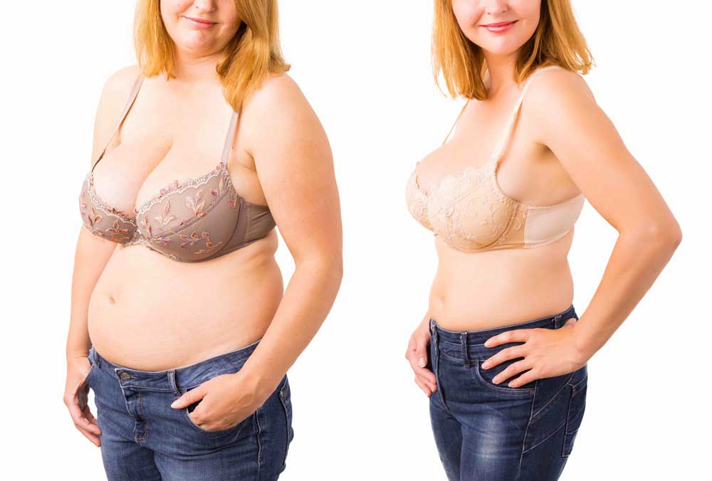Vorher-Nachher-Vergleich: Frau in Unterwäsche mit sichtbarem Gewichtsverlust