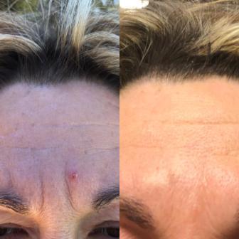 Chi statt Botox – Videokurs für Gesichtsyoga von Christina Schmied 5 Detailaufnahme Stirn-Falten vor und nach Chi-statt-Botox-Anwendung