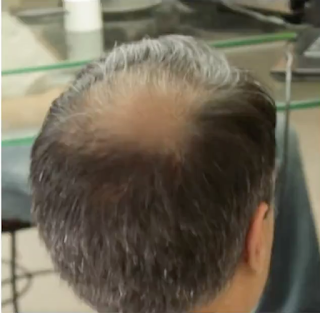Oberkopf eines Mannes von hinten mit verbessertem Haarwuchs nach Behandlung