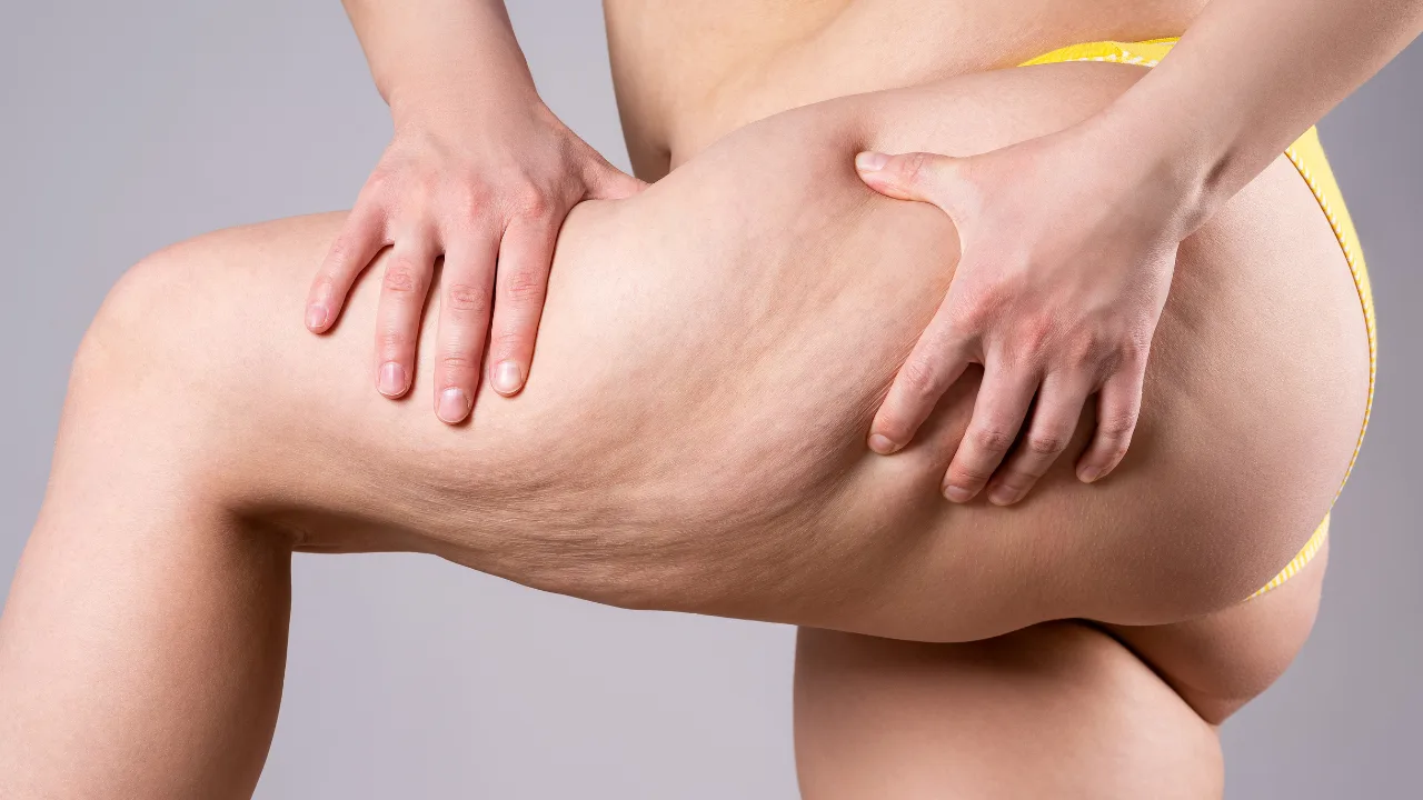 Frauenoberschenkel mit Cellulite, Finger drückt in die Haut