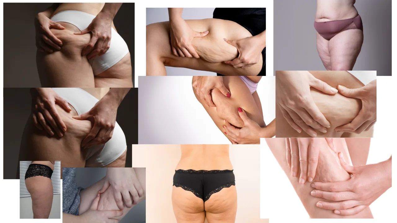 Collage von 9 Bildern zeigt verschiedene Körperzonen mit Cellulite und Hautproblemen