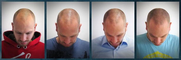 Vorher-Nachher Fotoserie eines Mannes mit Haarwuchsmittel Regaine für Männer in verschiedenen Stadien