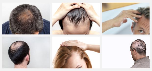 Galerie mit 6 Beispielfotos verschiedener Haarausfallformen bei Männern und Frauen