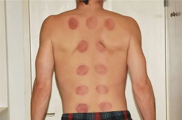 Reiki Behandlungen: Modul 3 – Videokurs zur Energiearbeit 8 Rückenansicht eines Mannes mit roten Schröpfflecken auf dem Rücken in Rasterform