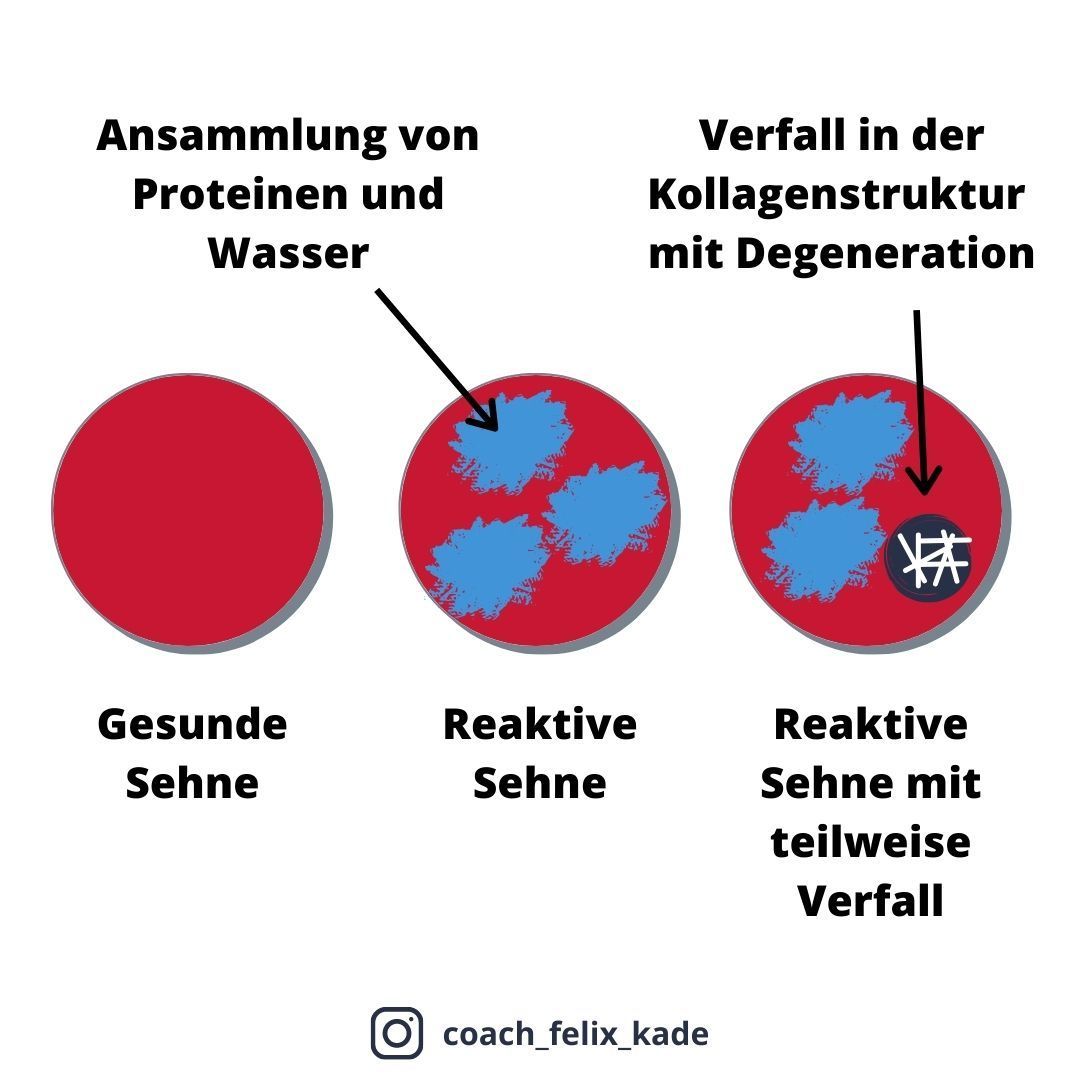 Infografik Sehnendegenerationen von gesunder Sehne bis reaktiver Sehne mit teilweisem Verfall